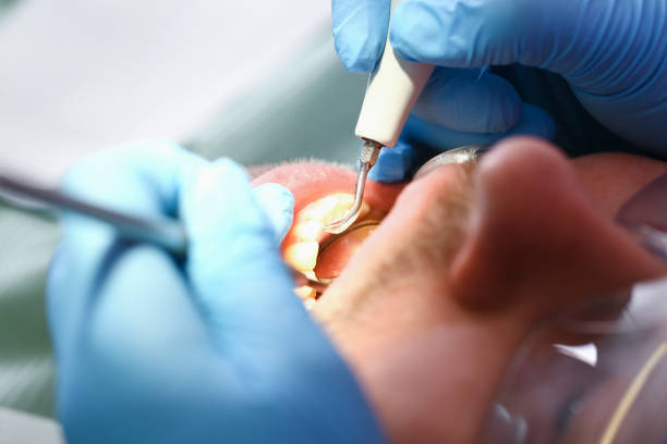 Best Knocked-Out Tooth (Avulsed Tooth) Treatment in Navesink, NJ